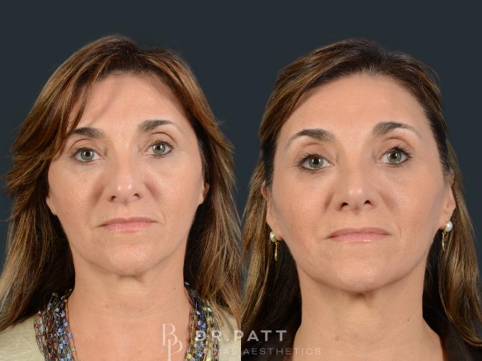 Before & After Rhinoplasty (Nose Job) Case 29 Front 1 View in Houston, TX