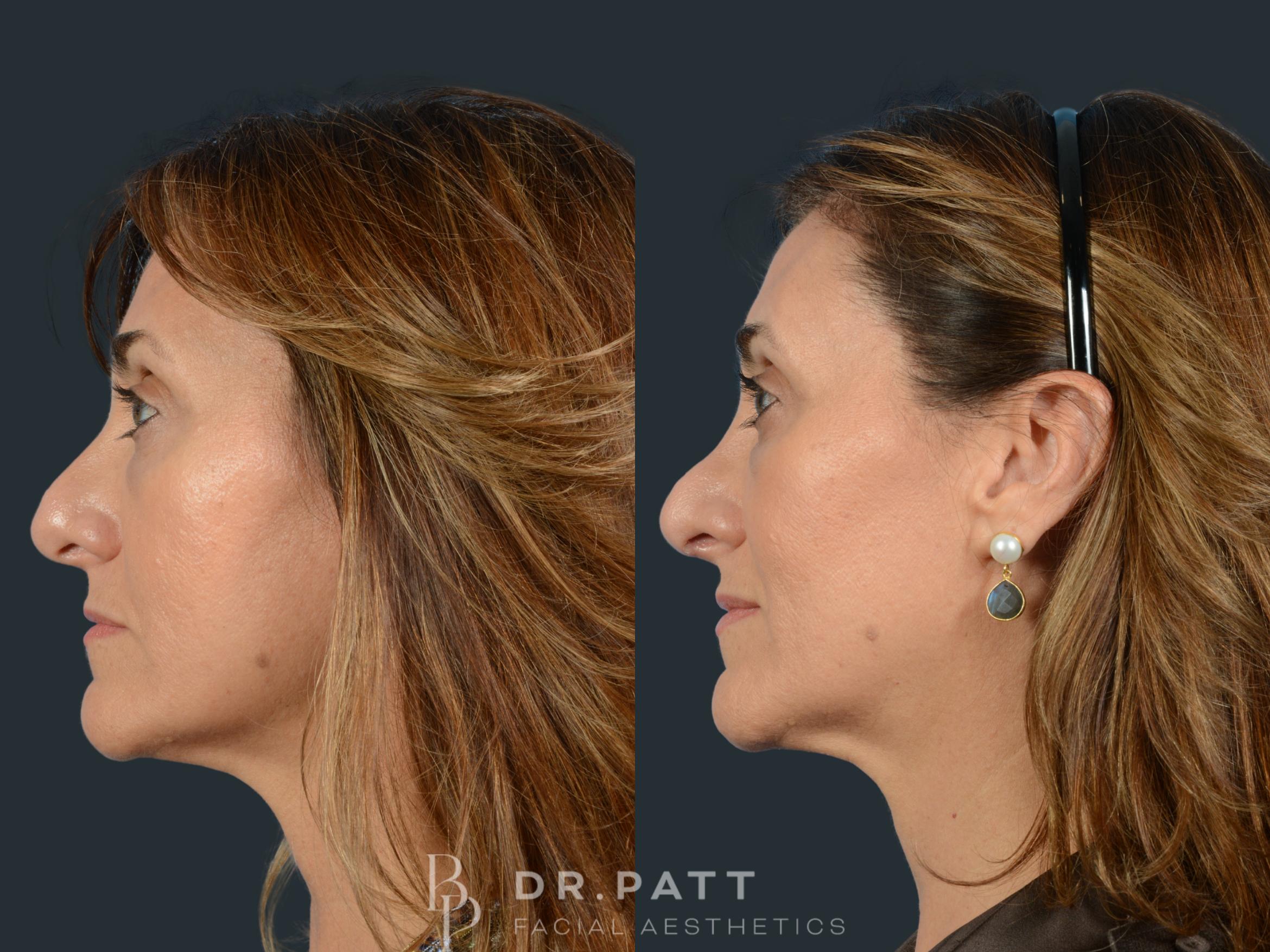 Before & After Rhinoplasty (Nose Job) Case 29 Left Side View in Houston, TX