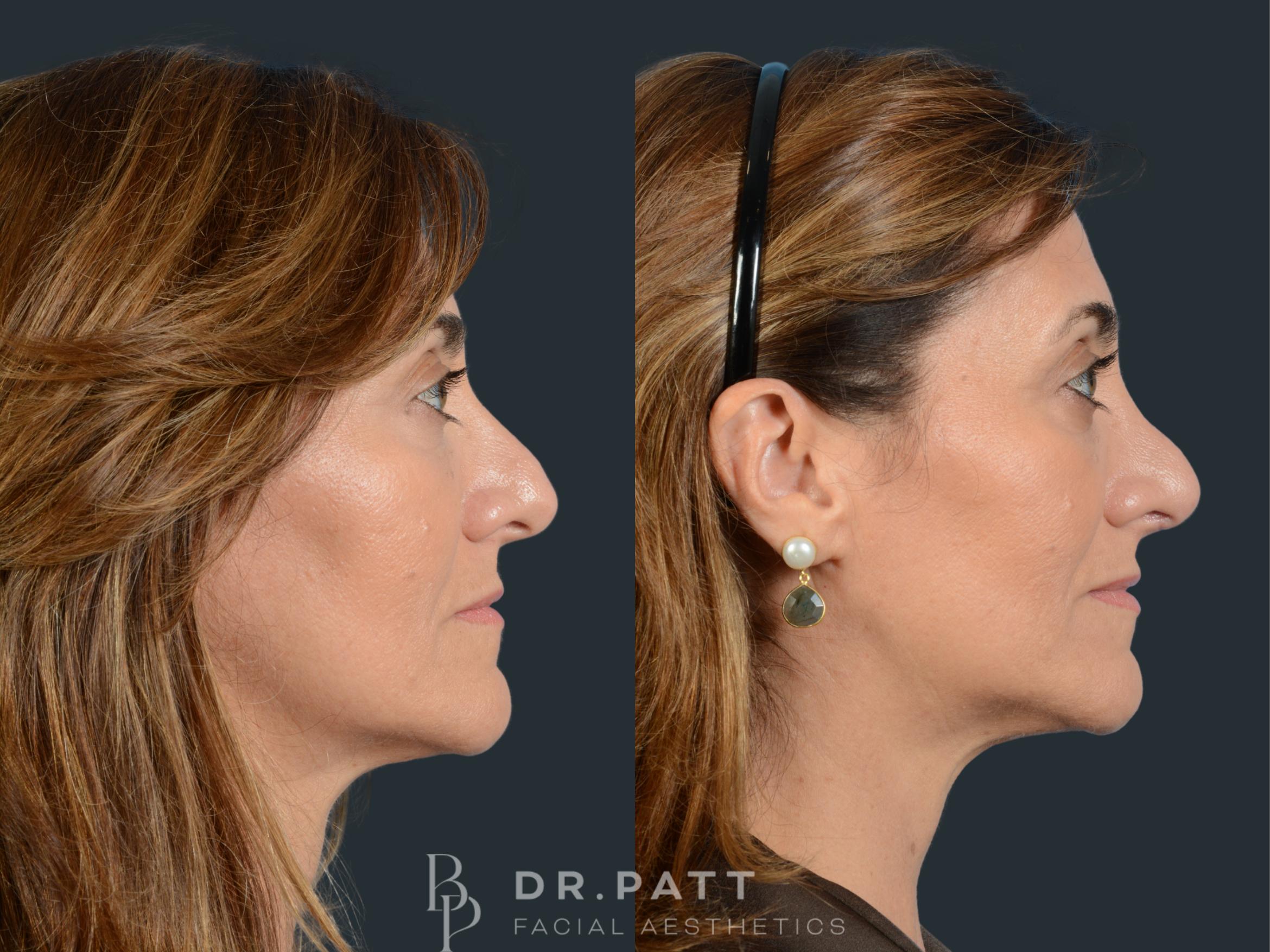 Before & After Rhinoplasty (Nose Job) Case 29 Right Side View in Houston, TX