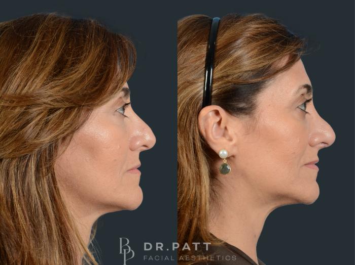 Before & After Rhinoplasty (Nose Job) Case 29 Right Side View in Houston, TX