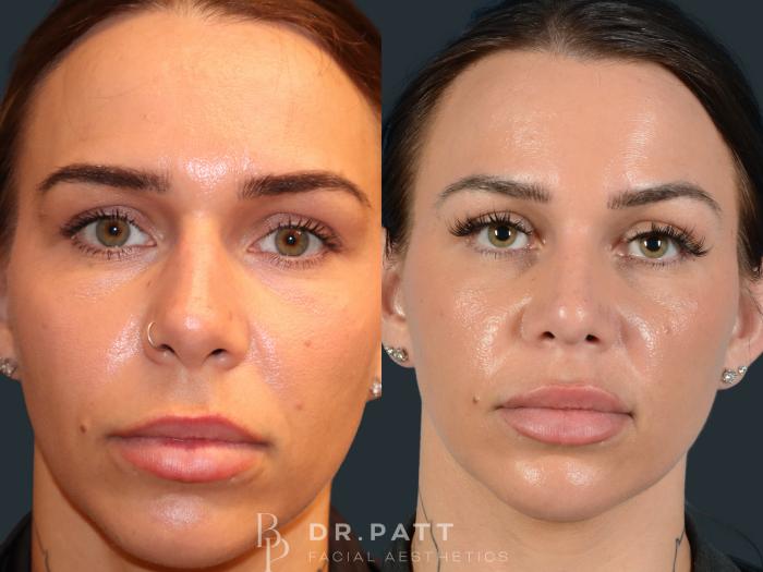 Before & After Rhinoplasty (Nose Job) Case 3 Front 1 View in Houston, TX