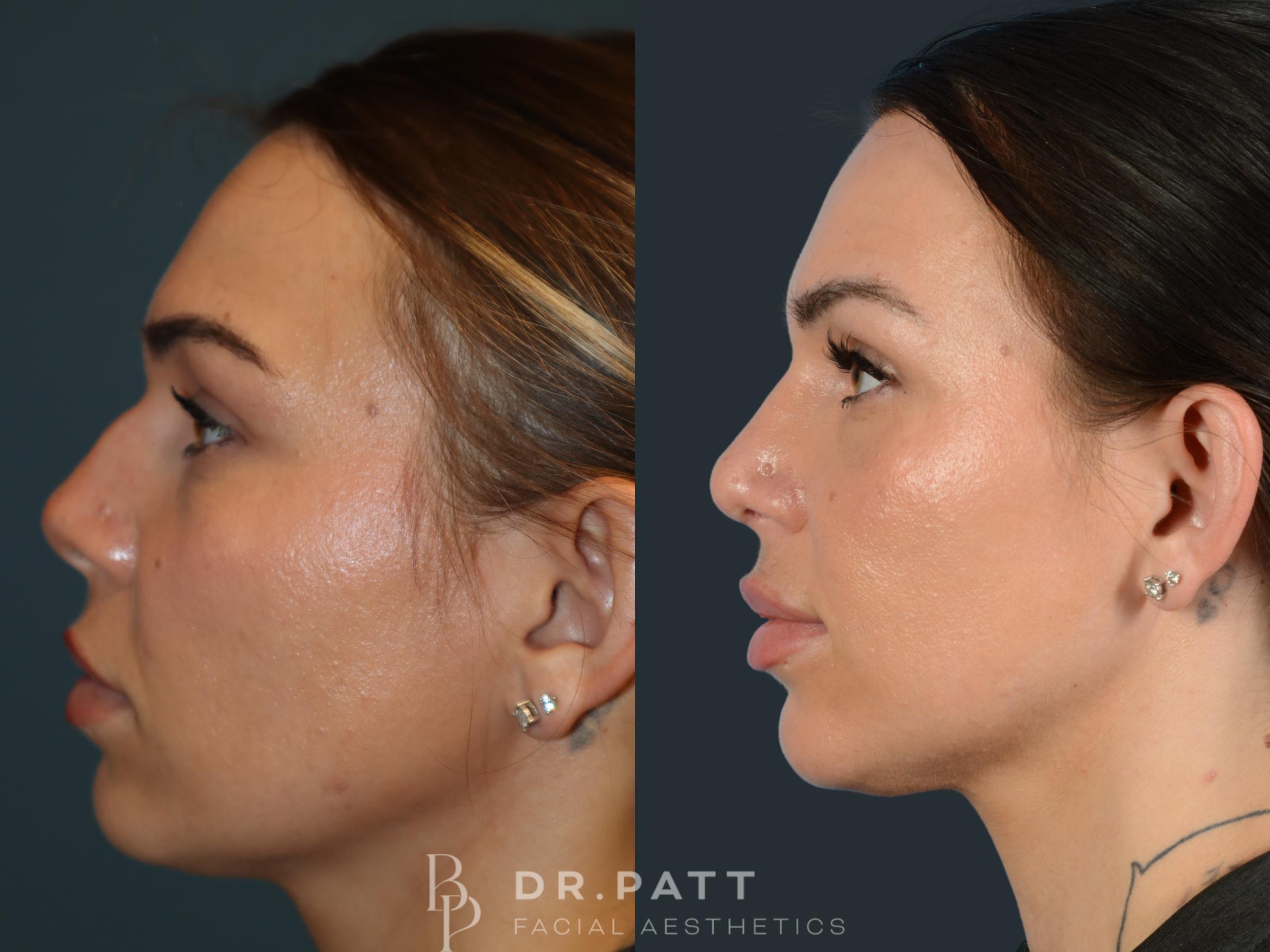 Before & After Rhinoplasty (Nose Job) Case 3 Left Side View in Houston, TX