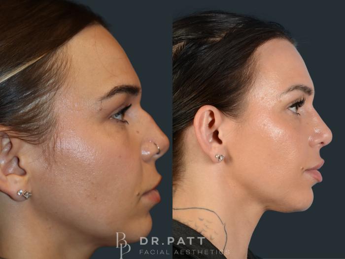 Before & After Rhinoplasty (Nose Job) Case 3 Right Side View in Houston, TX