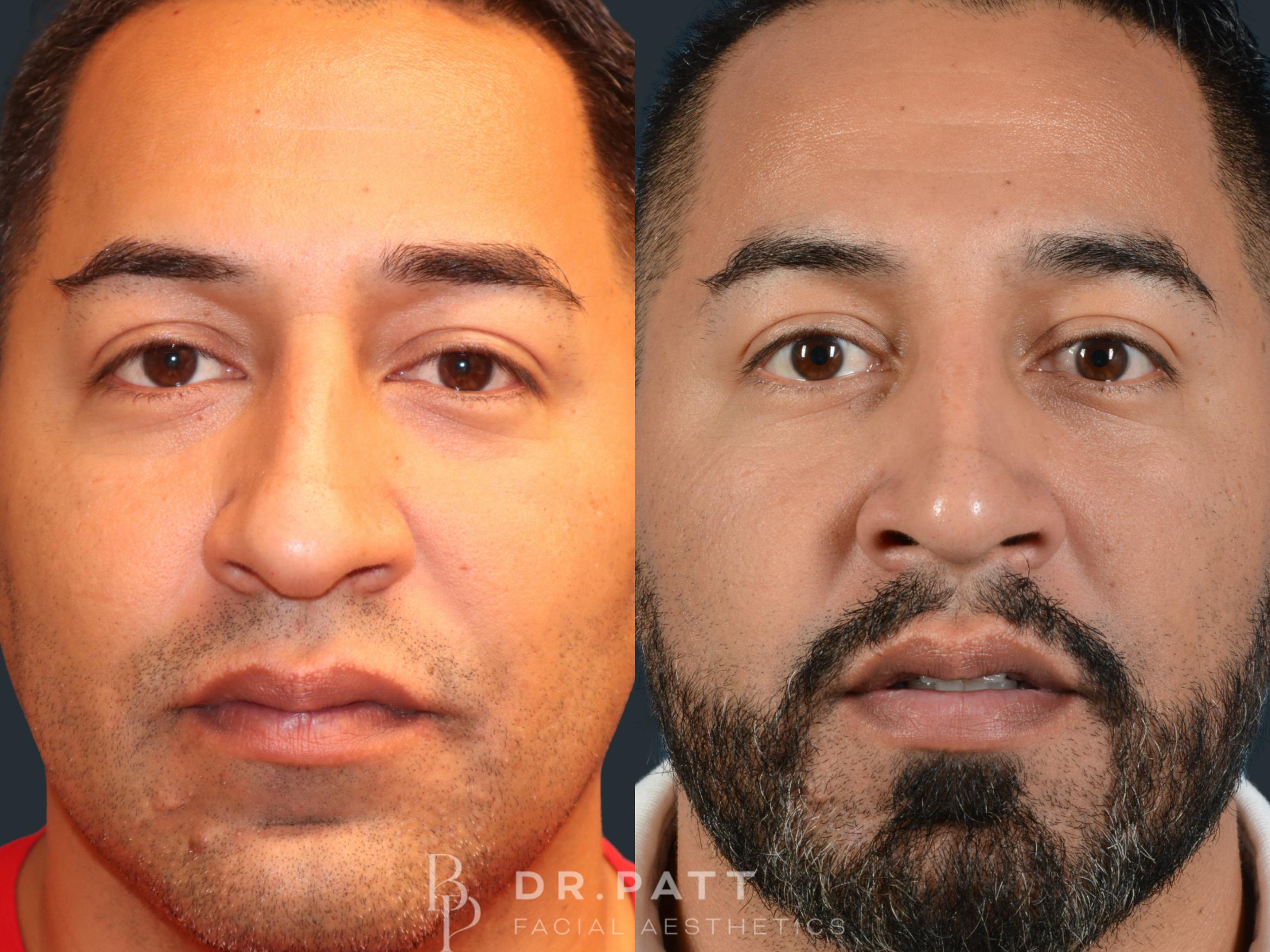 Before & After Rhinoplasty (Nose Job) Case 30 Front 1 View in Houston, TX