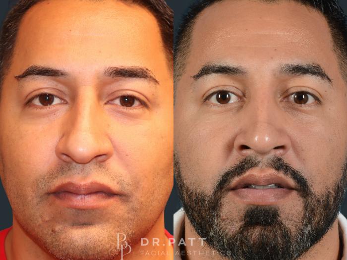 Before & After Rhinoplasty (Nose Job) Case 30 Front 1 View in Houston, TX