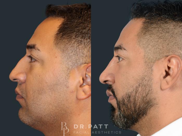 Before & After Rhinoplasty (Nose Job) Case 30 Left Side View in Houston, TX