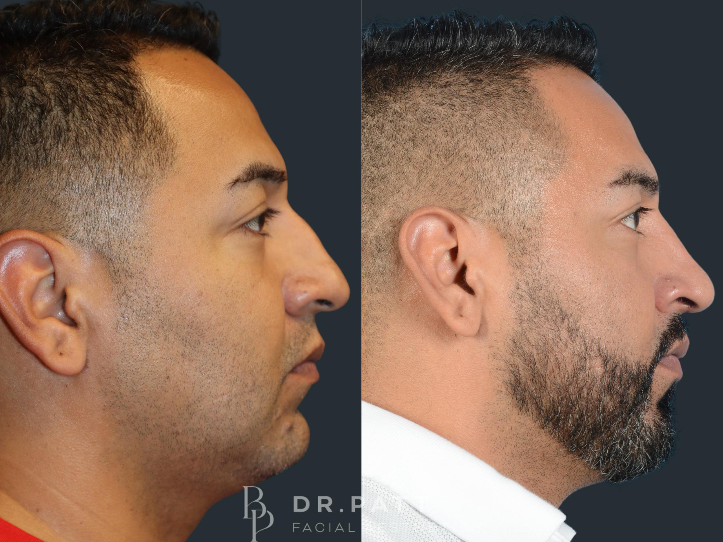 Before & After Rhinoplasty (Nose Job) Case 30 Right Side View in Houston, TX