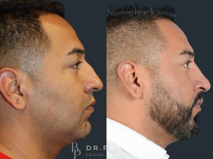 Before & After Rhinoplasty (Nose Job) Case 30 Right Side View in Houston, TX