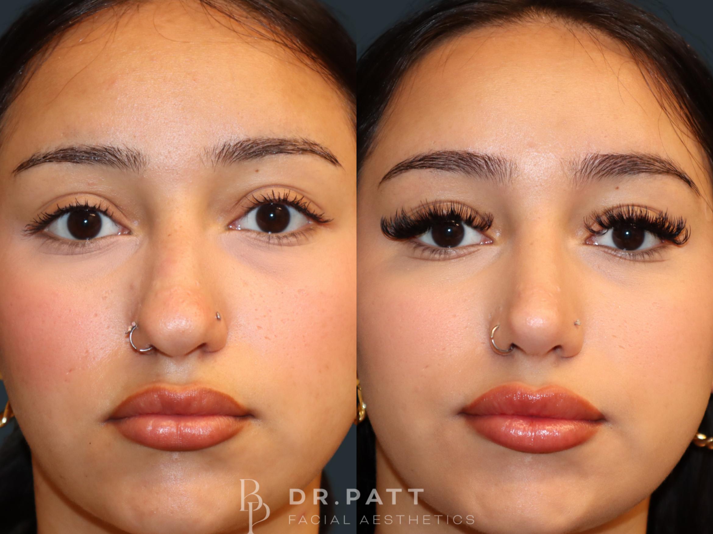 Before & After Rhinoplasty (Nose Job) Case 31 Front 1 View in Houston, TX