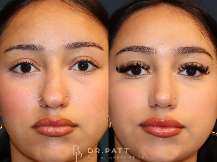 Before & After Rhinoplasty (Nose Job) Case 31 Front 1 View in Houston, TX