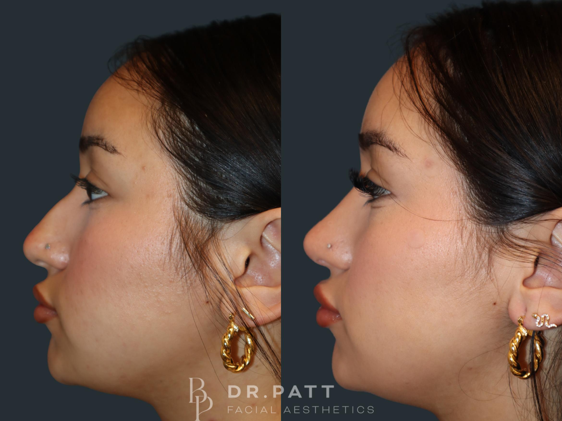 Before & After Rhinoplasty (Nose Job) Case 31 Left Side View in Houston, TX