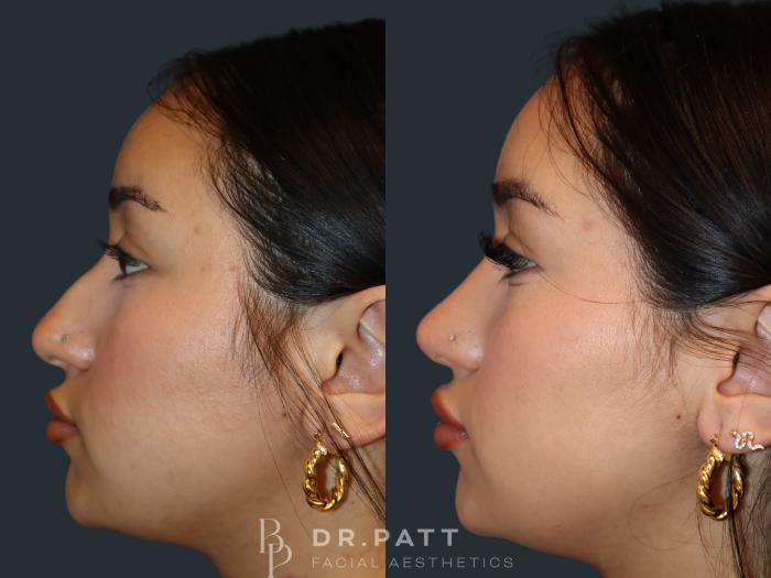 Before & After Rhinoplasty (Nose Job) Case 31 Left Side View in Houston, TX
