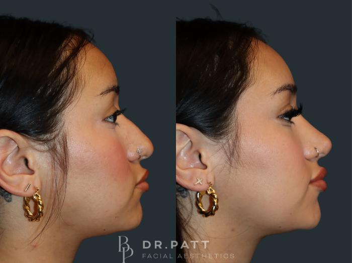 Before & After Rhinoplasty (Nose Job) Case 31 Right Side View in Houston, TX