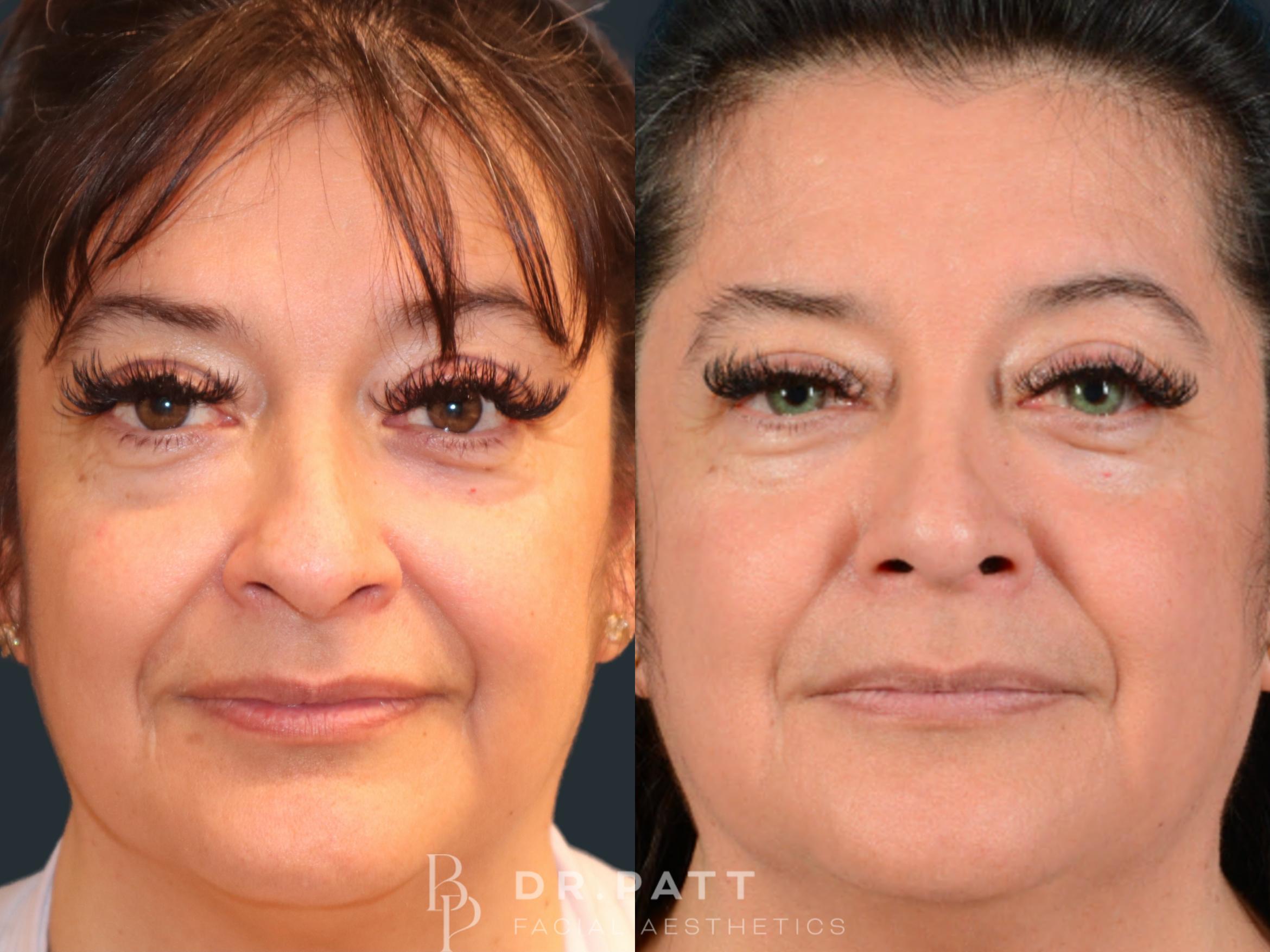 Before & After Rhinoplasty (Nose Job) Case 32 Front 1 View in Houston, TX