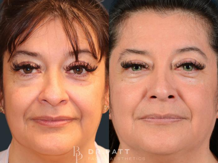 Before & After Rhinoplasty (Nose Job) Case 32 Front 1 View in Houston, TX