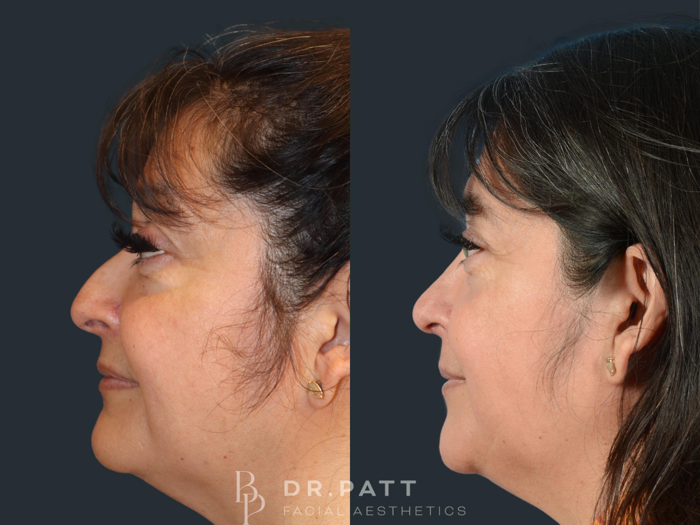 Before & After Rhinoplasty (Nose Job) Case 32 Left Side View in Houston, TX