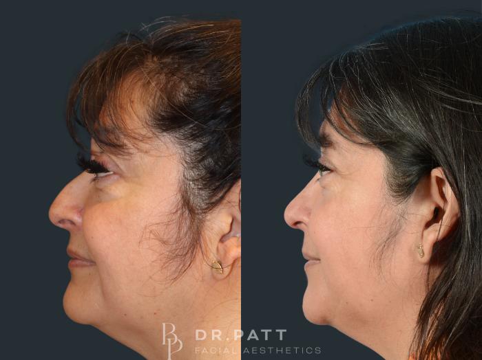 Before & After Rhinoplasty (Nose Job) Case 32 Left Side View in Houston, TX