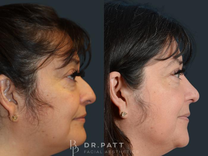 Before & After Rhinoplasty (Nose Job) Case 32 Right Side View in Houston, TX