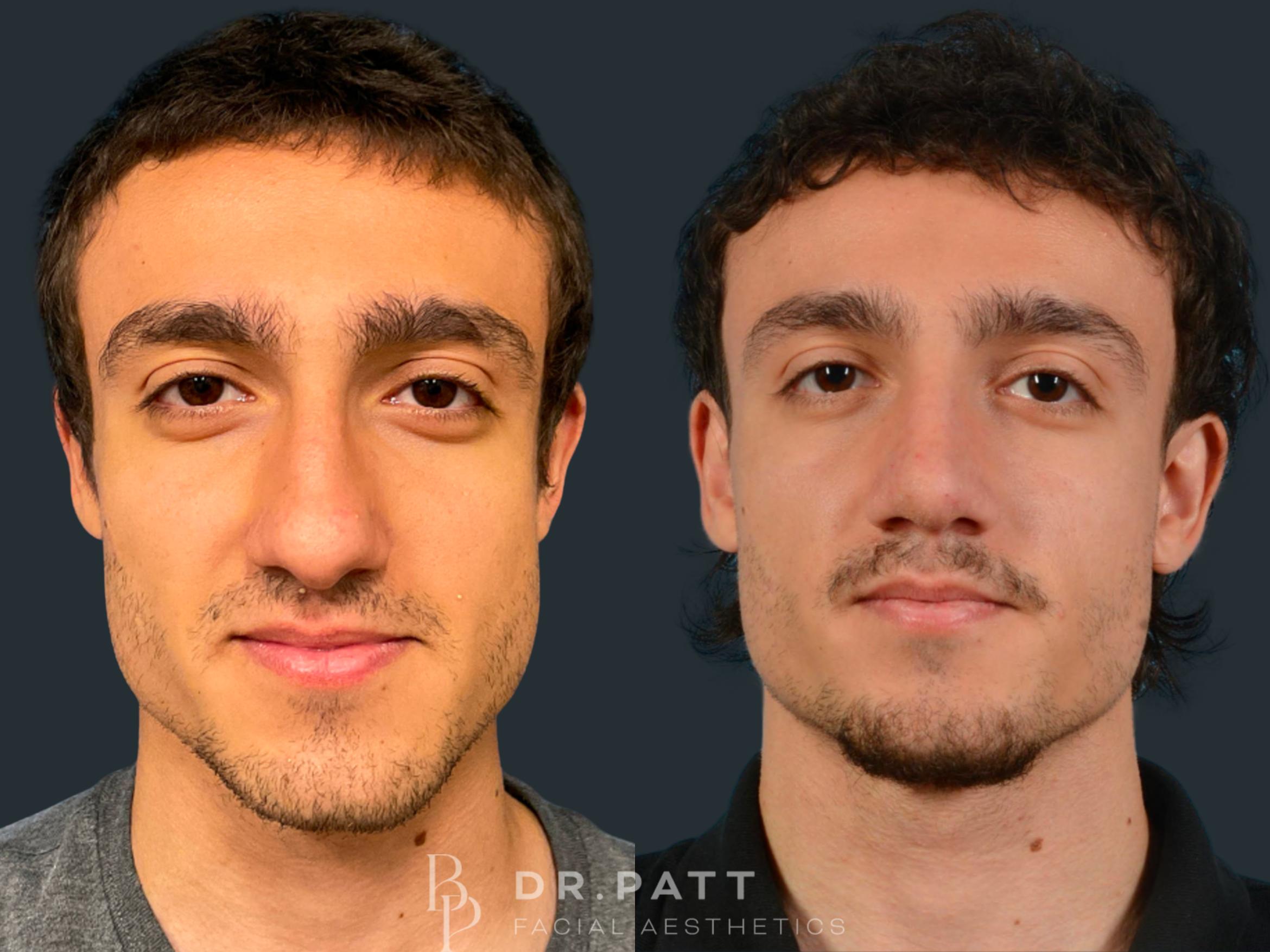 Before & After Rhinoplasty (Nose Job) Case 33 Front 1 View in Houston, TX