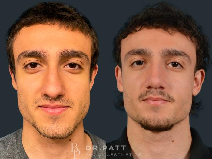 Before & After Rhinoplasty (Nose Job) Case 33 Front 1 View in Houston, TX