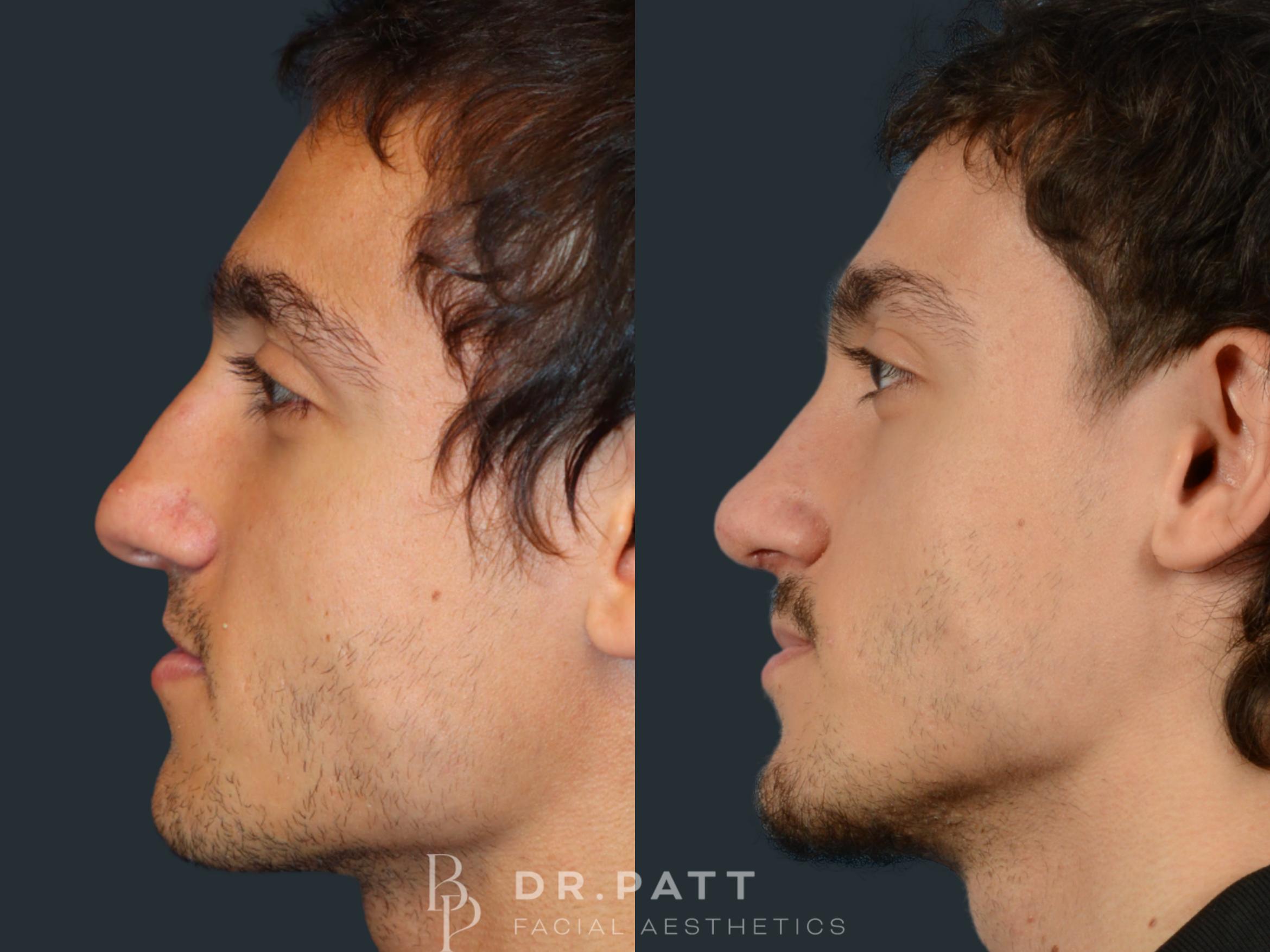 Before & After Rhinoplasty (Nose Job) Case 33 Left Side View in Houston, TX