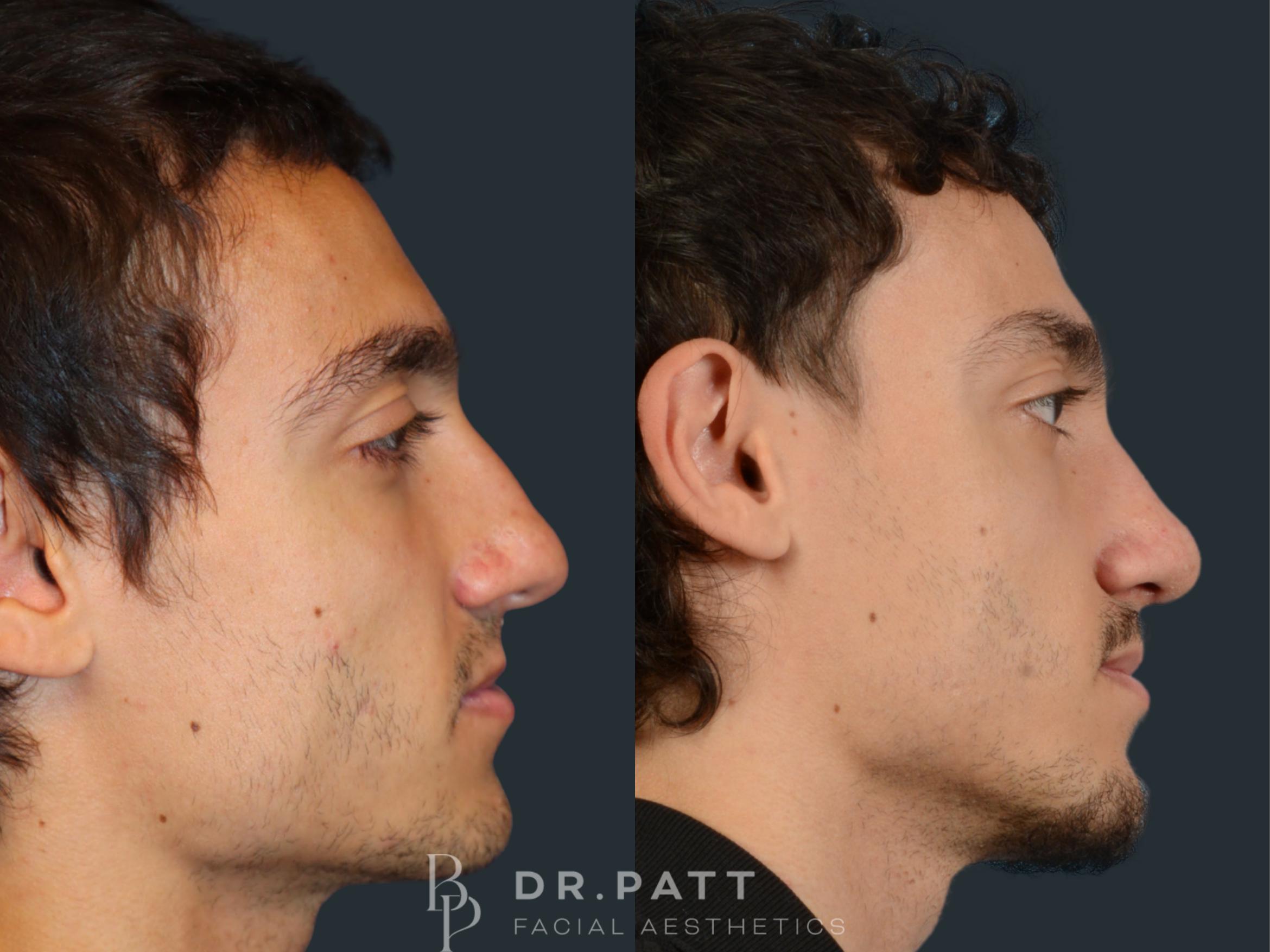 Before & After Rhinoplasty (Nose Job) Case 33 Right Side View in Houston, TX