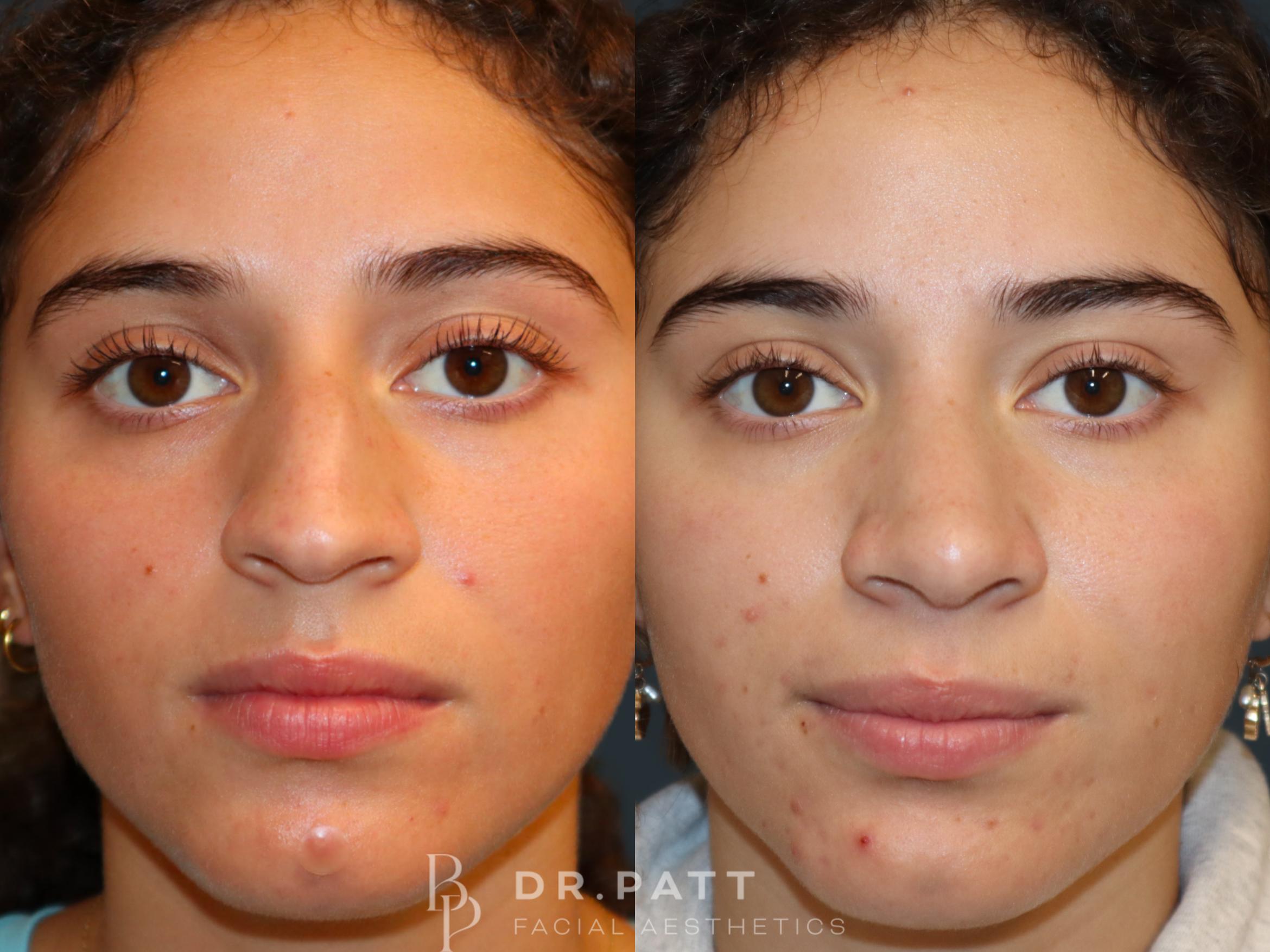 Before & After Rhinoplasty (Nose Job) Case 34 Front 1 View in Houston, TX