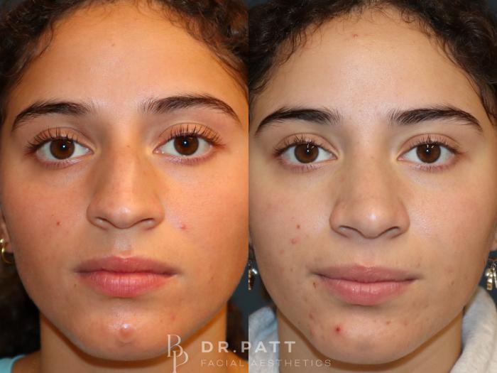 Before & After Rhinoplasty (Nose Job) Case 34 Front 1 View in Houston, TX