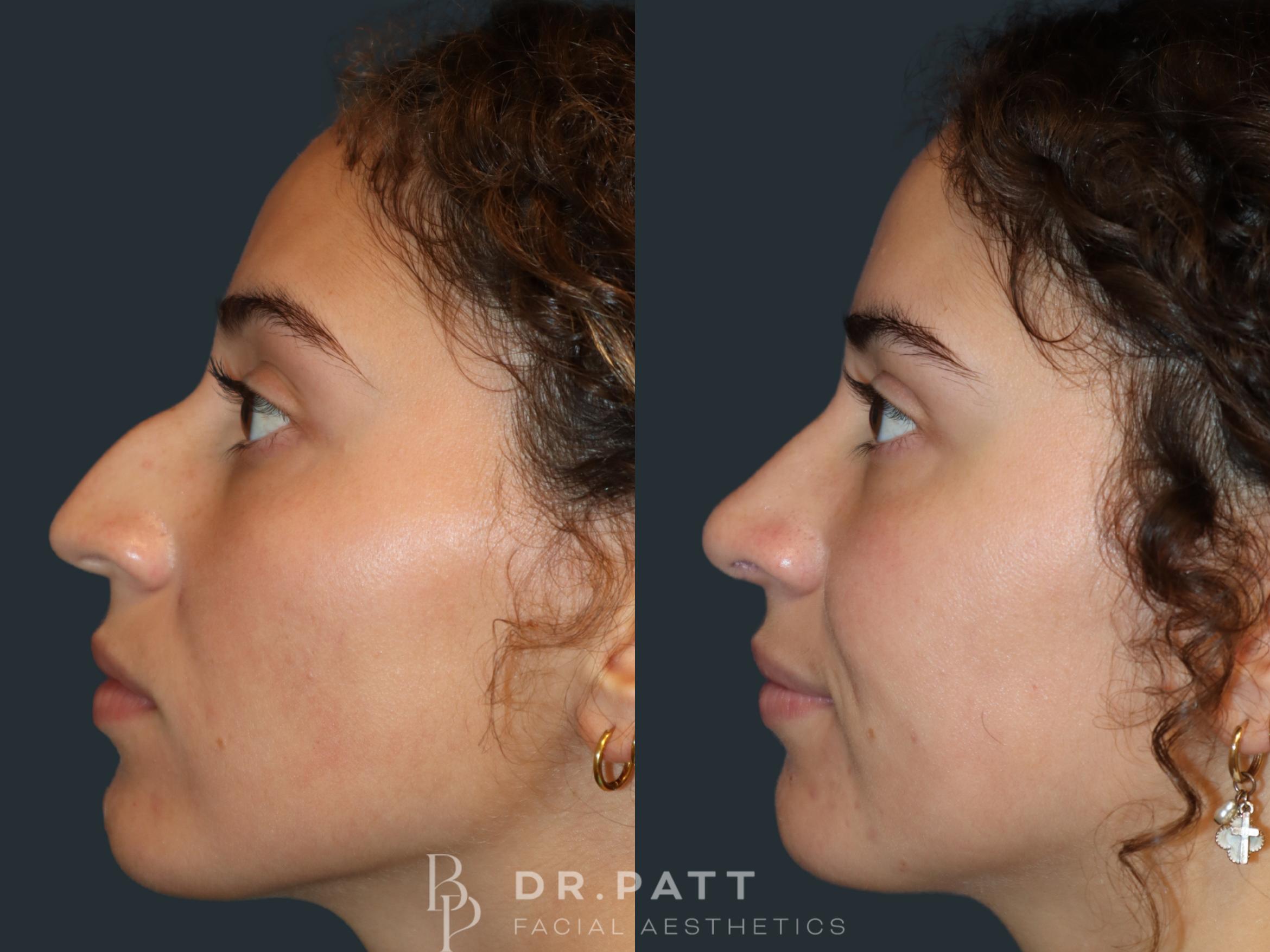 Before & After Rhinoplasty (Nose Job) Case 34 Left Side View in Houston, TX