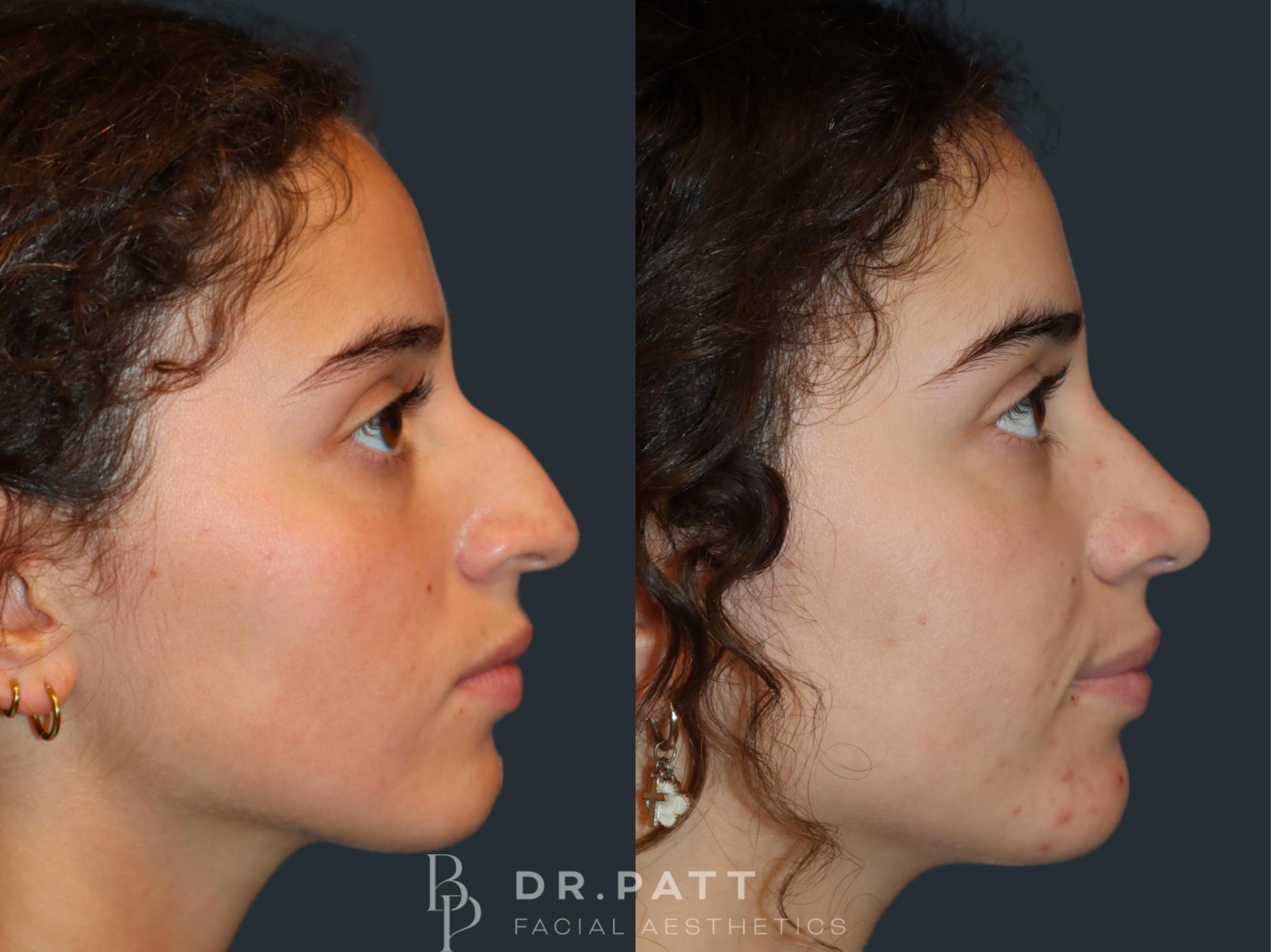 Before & After Rhinoplasty (Nose Job) Case 34 Right Side View in Houston, TX