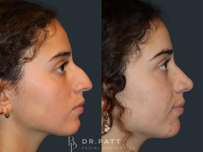 Before & After Rhinoplasty (Nose Job) Case 34 Right Side View in Houston, TX