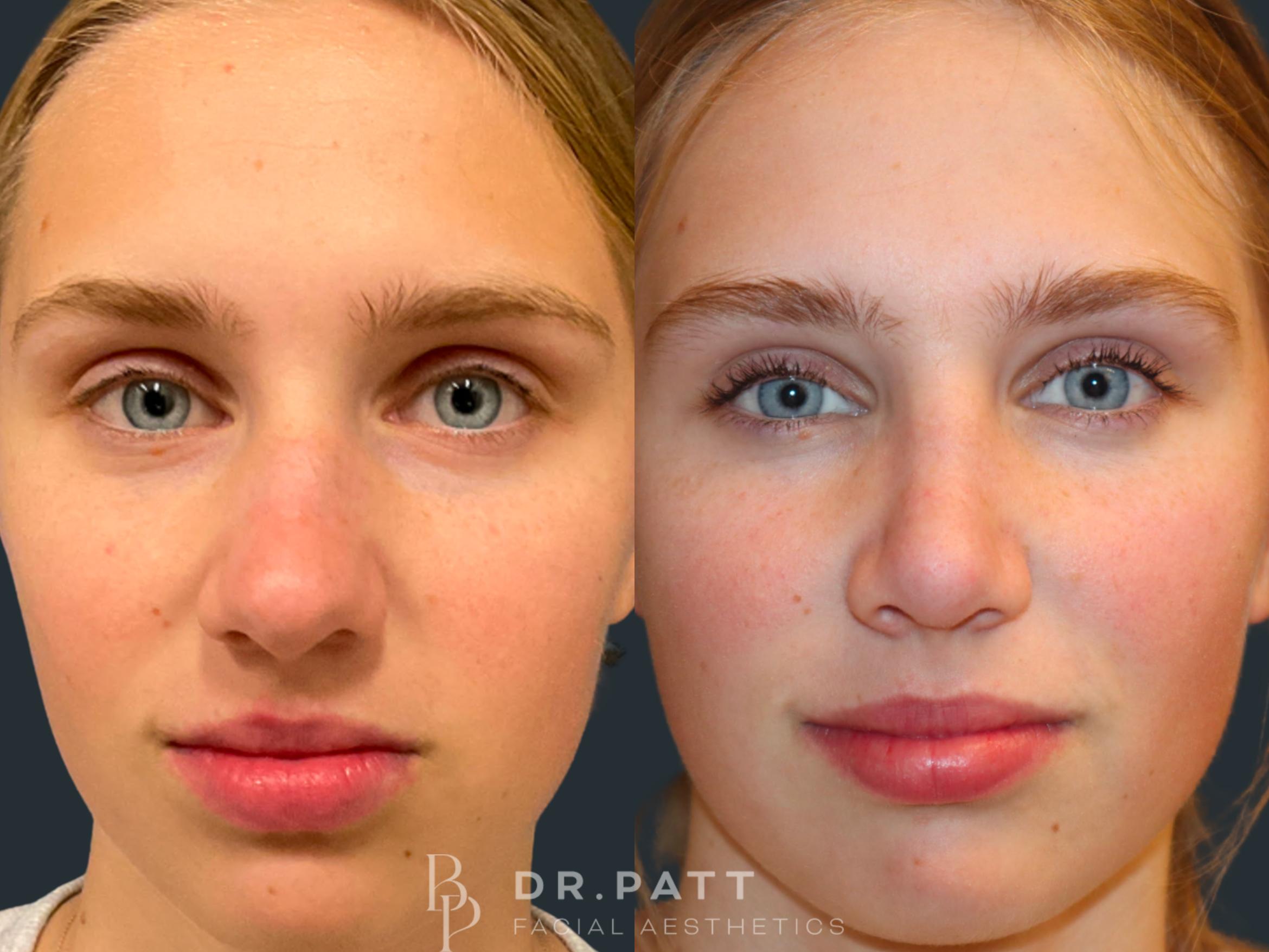 Before & After Rhinoplasty (Nose Job) Case 35 Front 1 View in Houston, TX
