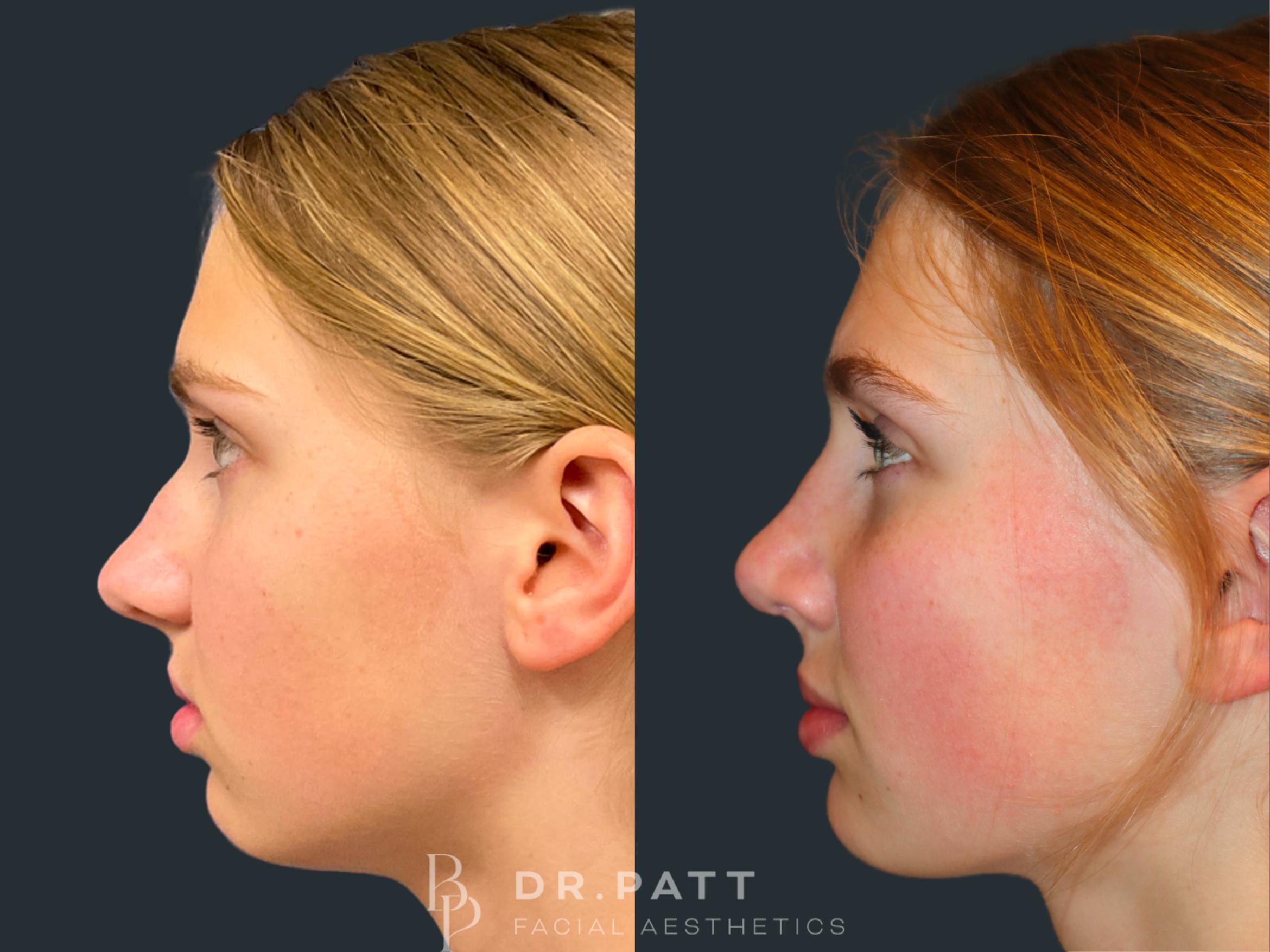 Before & After Rhinoplasty (Nose Job) Case 35 Left Side View in Houston, TX