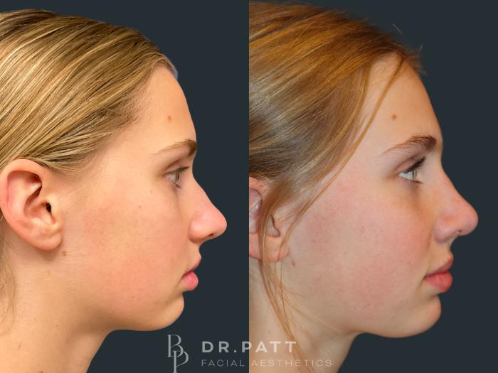 Before & After Rhinoplasty (Nose Job) Case 35 Right Side View in Houston, TX