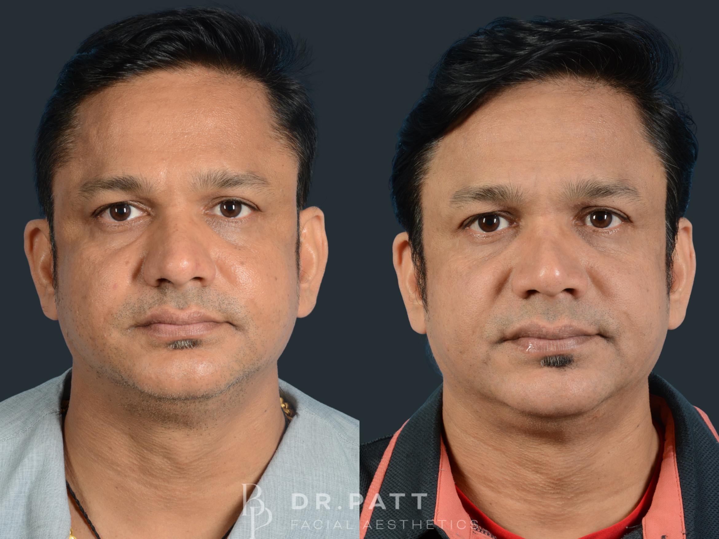 Before & After Rhinoplasty (Nose Job) Case 4 Front 1 View in Houston, TX