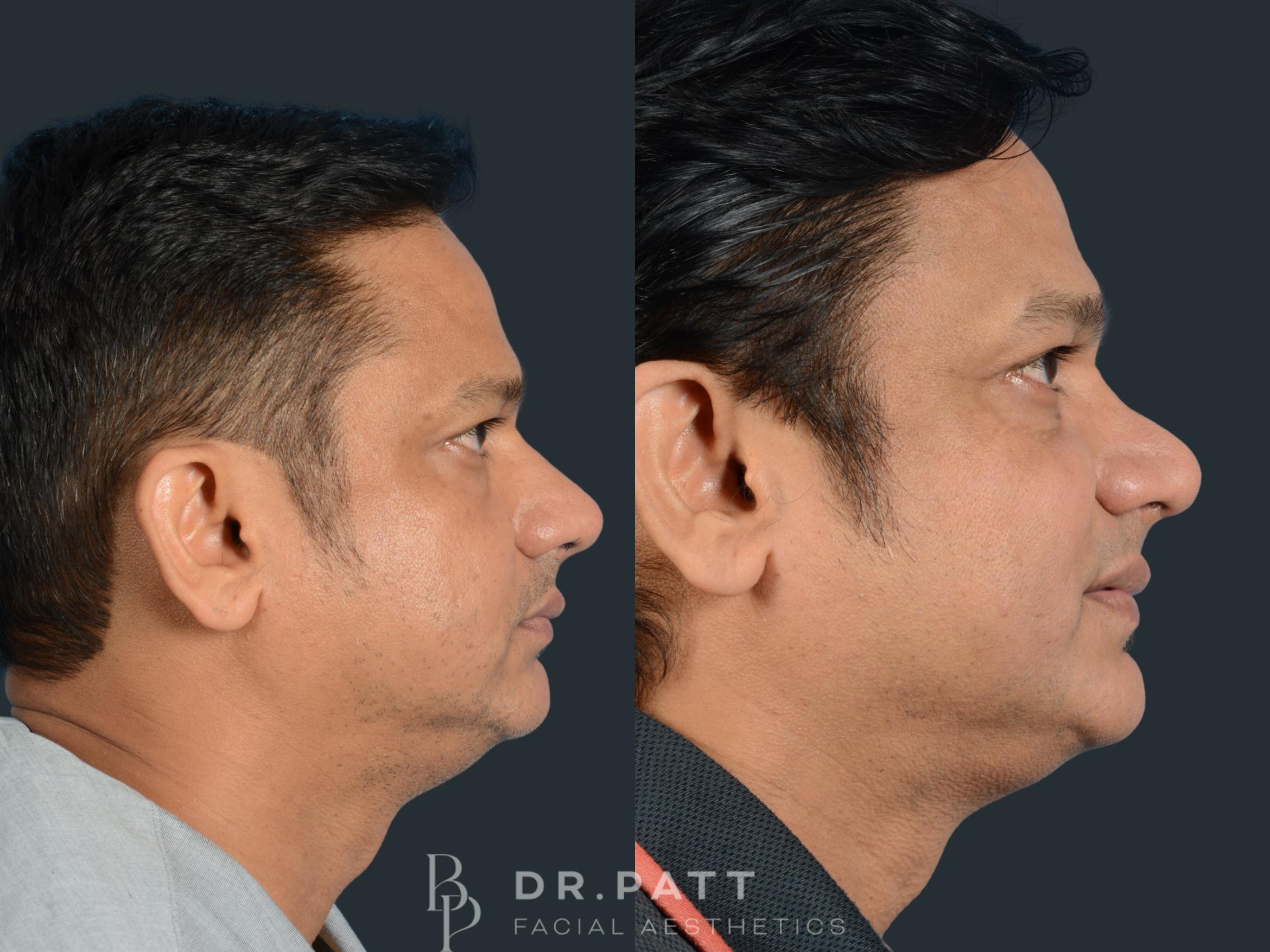 Before & After Rhinoplasty (Nose Job) Case 4 Left Side View in Houston, TX