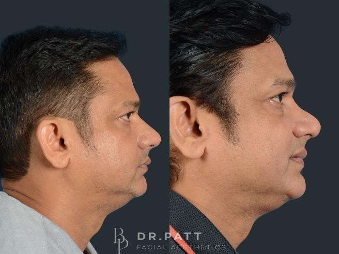 Before & After Rhinoplasty (Nose Job) Case 4 Left Side View in Houston, TX