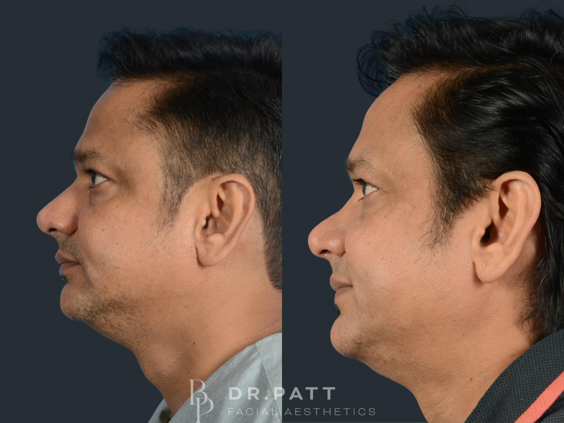 Before & After Rhinoplasty (Nose Job) Case 4 Right Side View in Houston, TX