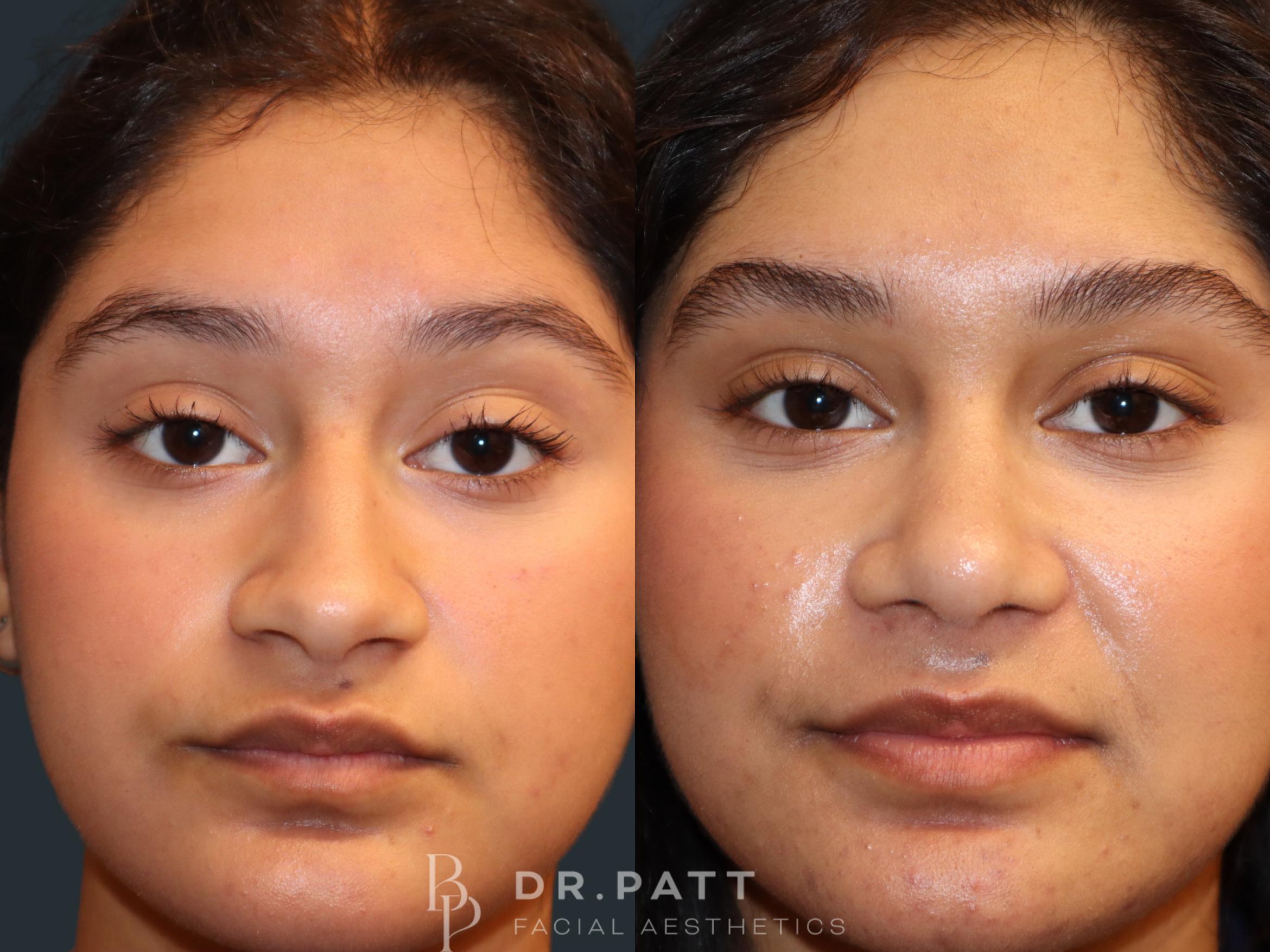 Before & After Rhinoplasty (Nose Job) Case 49 Front View in Houston, TX