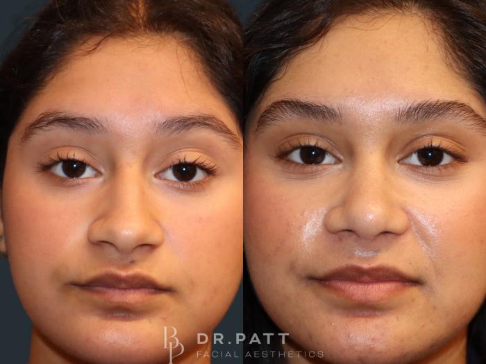 Before & After Rhinoplasty (Nose Job) Case 49 Front View in Houston, TX
