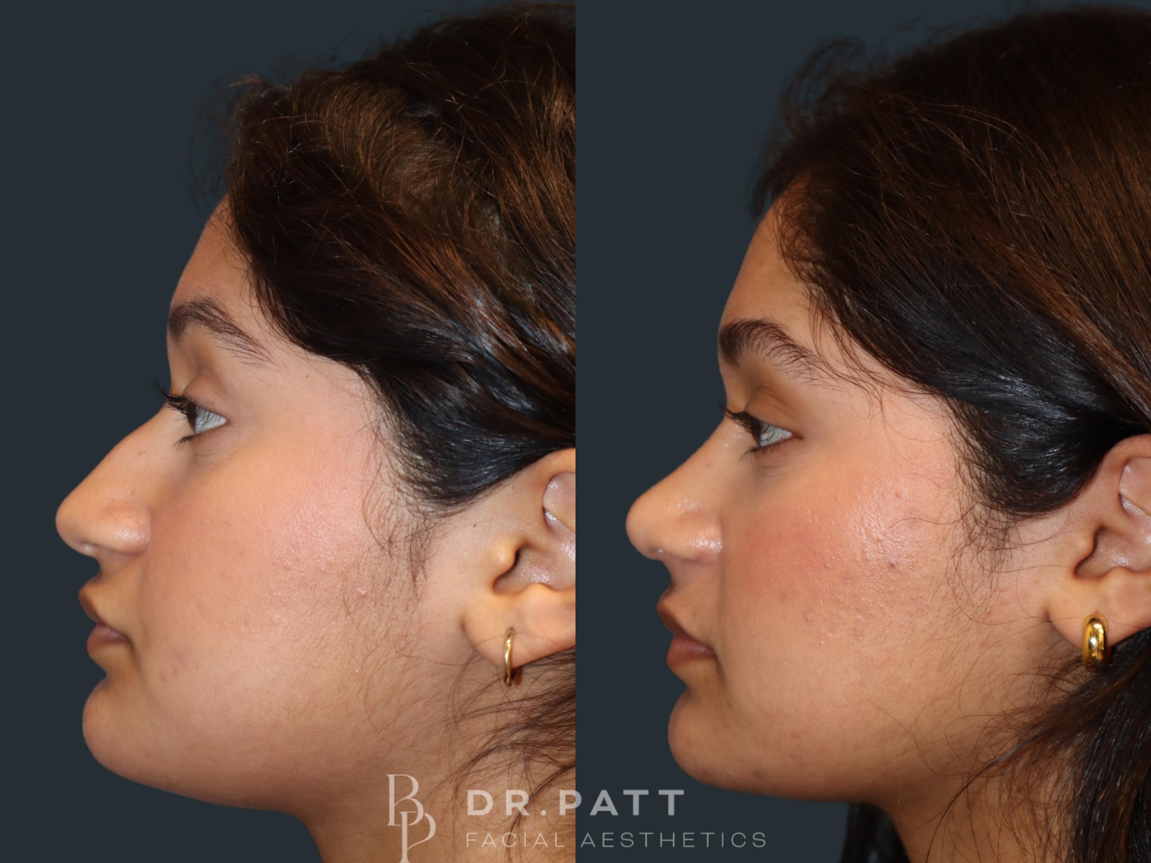 Before & After Rhinoplasty (Nose Job) Case 49 Left Side View in Houston, TX