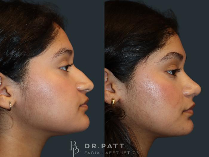 Before & After Rhinoplasty (Nose Job) Case 49 Right Side View in Houston, TX