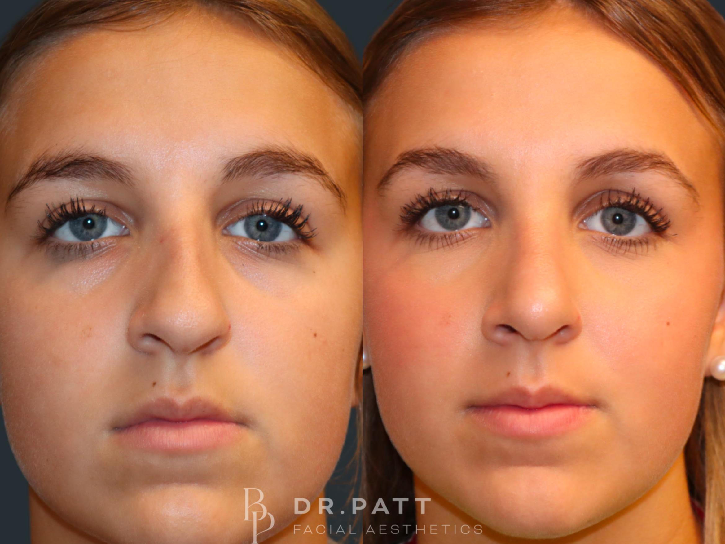 Before & After Rhinoplasty (Nose Job) Case 5 Front 1 View in Houston, TX