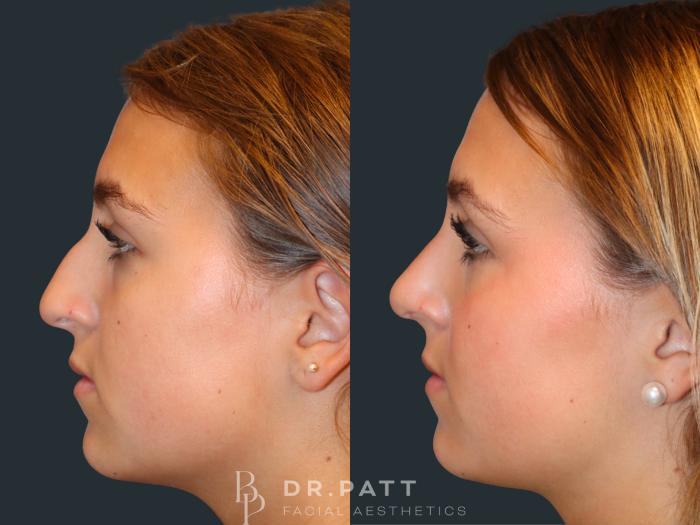 Before & After Rhinoplasty (Nose Job) Case 5 Left Side View in Houston, TX