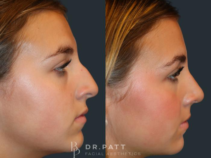 Before & After Rhinoplasty (Nose Job) Case 5 Right Side View in Houston, TX
