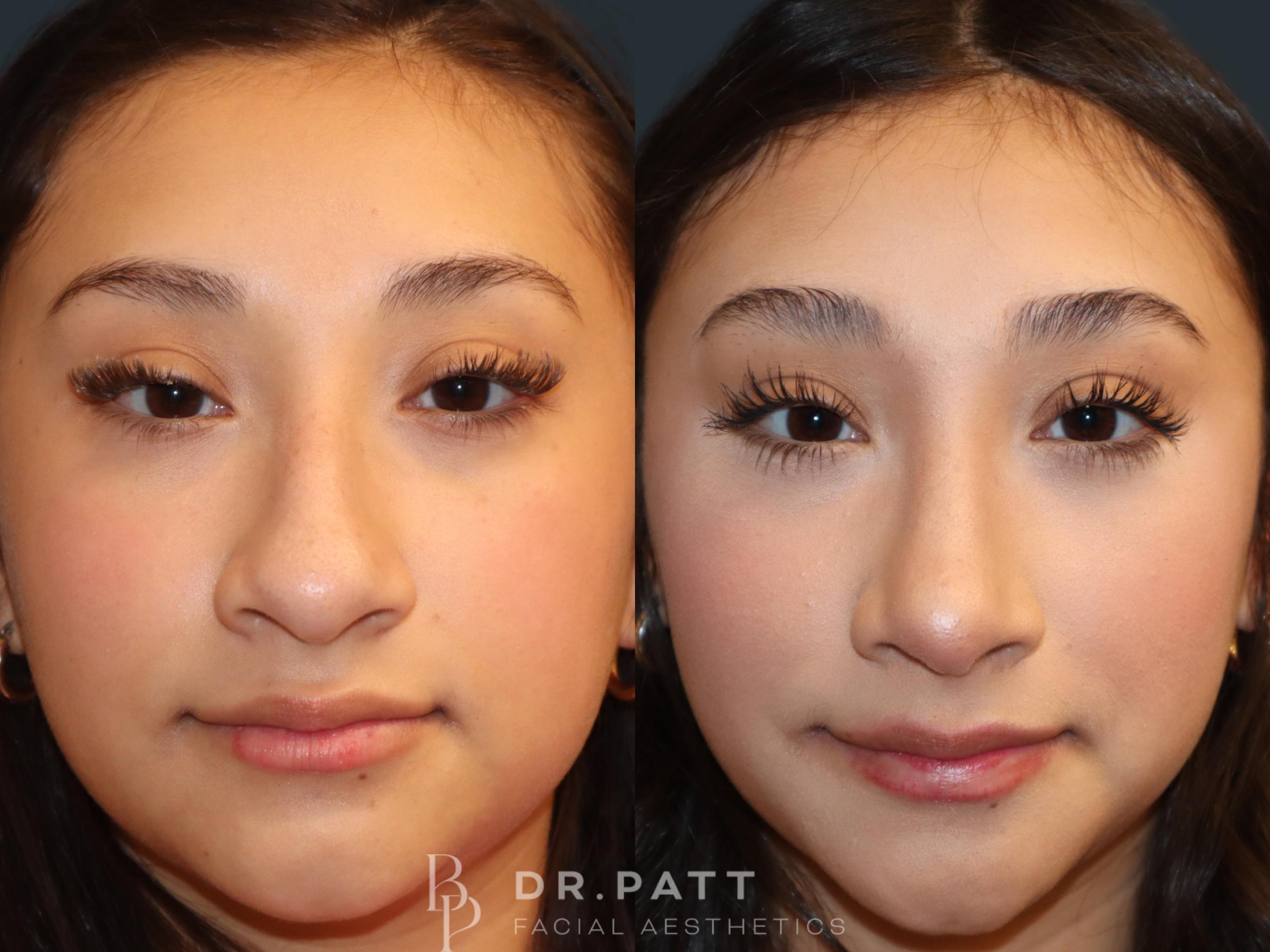 Before & After Rhinoplasty (Nose Job) Case 50 Front View in Houston, TX