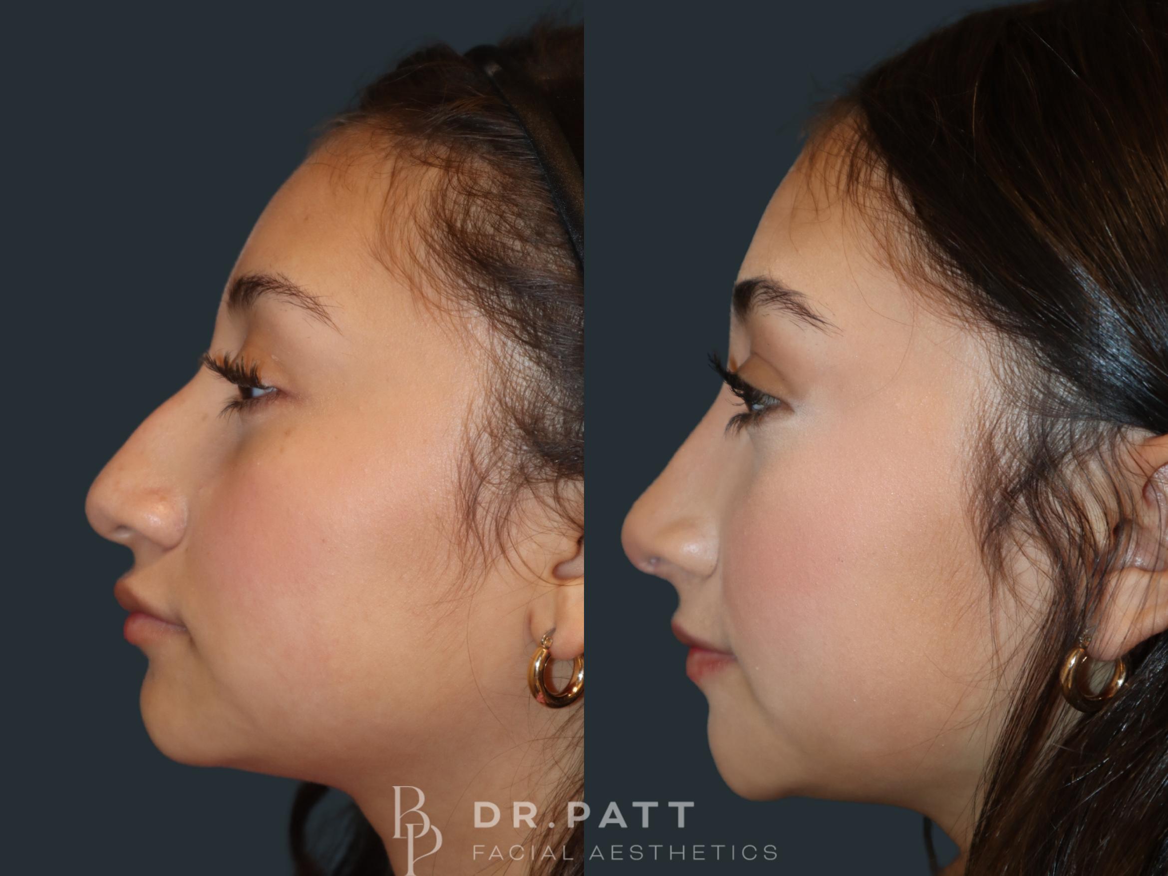 Before & After Rhinoplasty (Nose Job) Case 50 Left Side View in Houston, TX