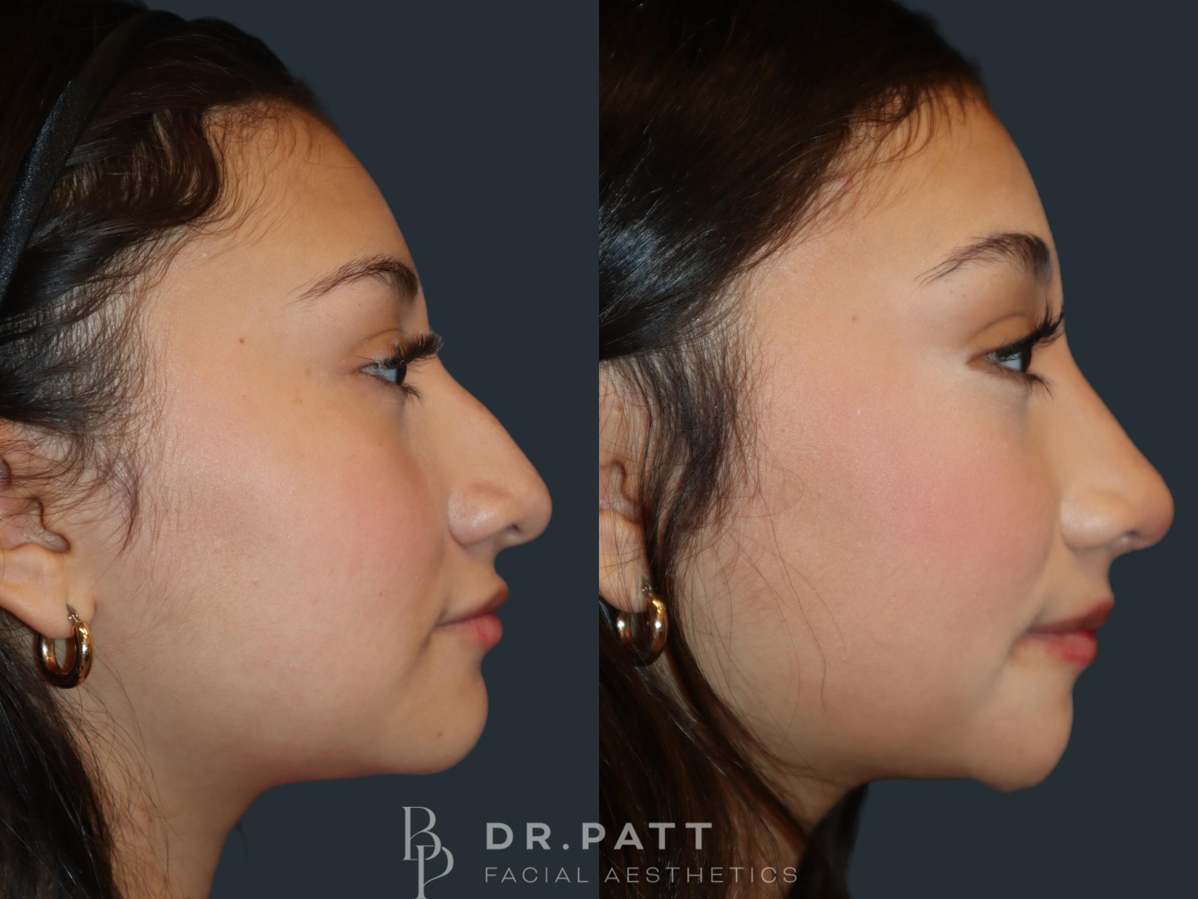 Before & After Rhinoplasty (Nose Job) Case 50 Right Side View in Houston, TX