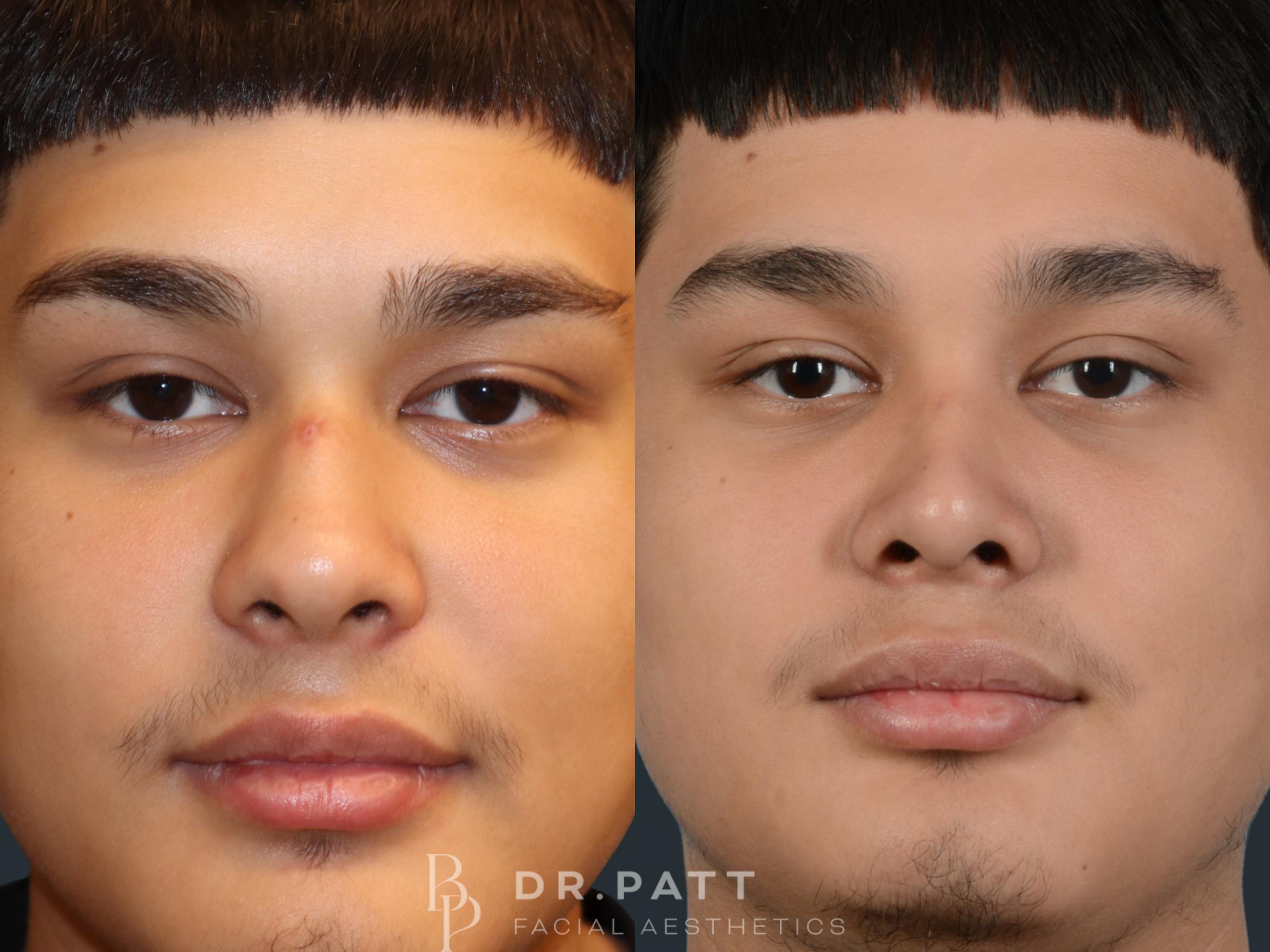 Before & After Rhinoplasty (Nose Job) Case 6 Front 1 View in Houston, TX