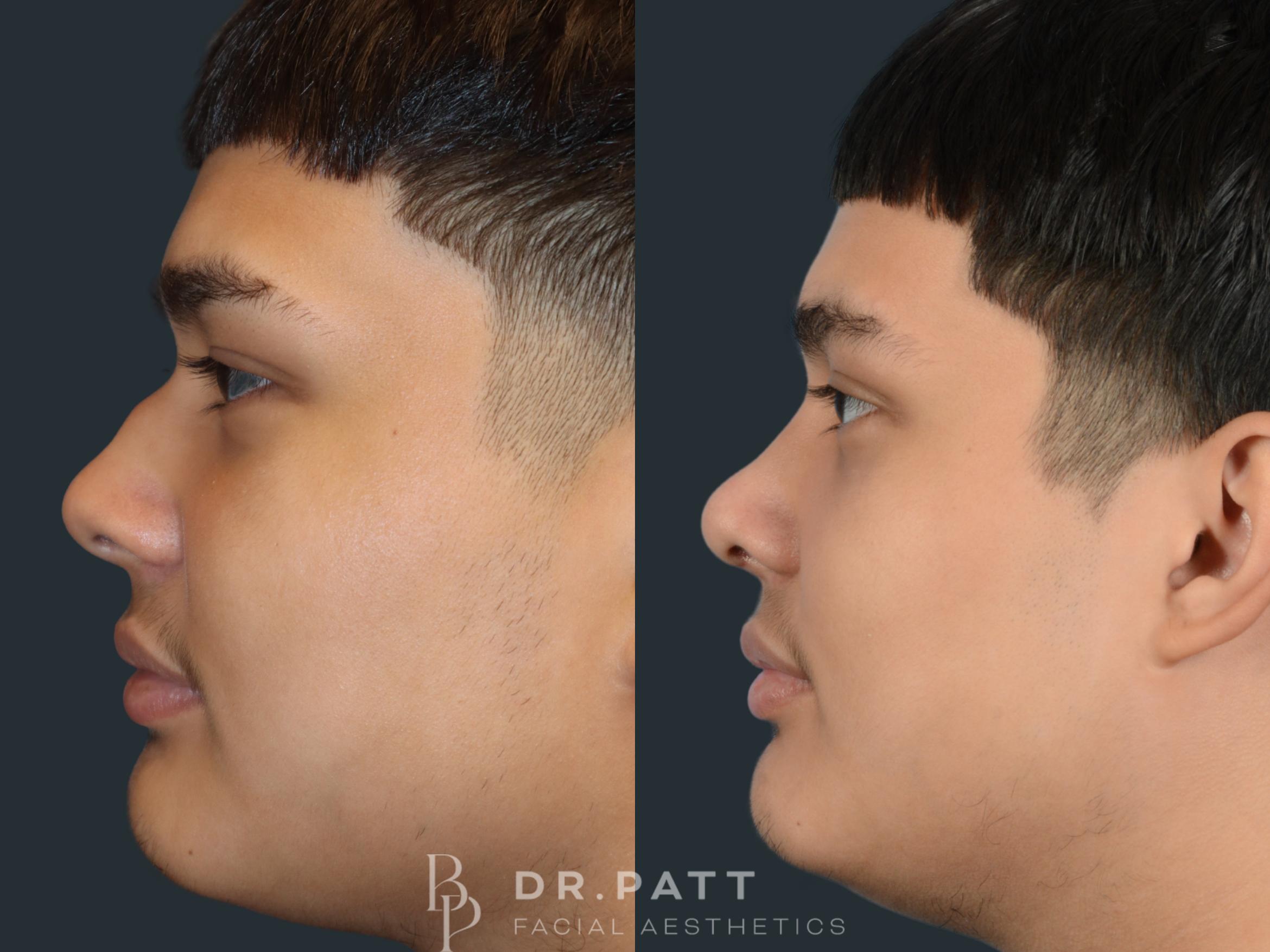 Before & After Rhinoplasty (Nose Job) Case 6 Left Side View in Houston, TX
